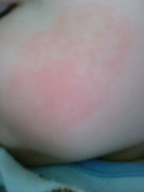 heat rash. baby heat rash symptoms